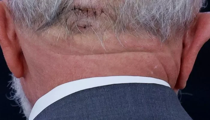 Presidente Lula em recuperação após cirurgia emergencial.